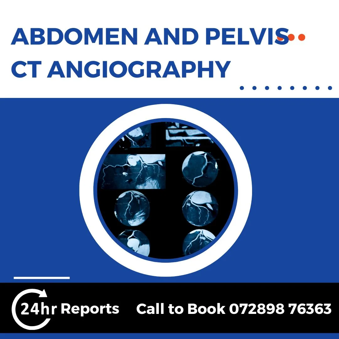 Abdomen And Pelvis CT Angiography