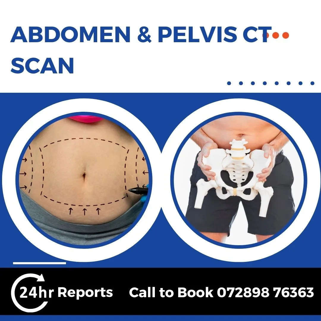 Abdomen And Pelvis CT Scan