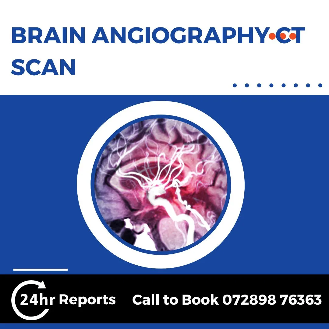 Brain Angiography CT Scan