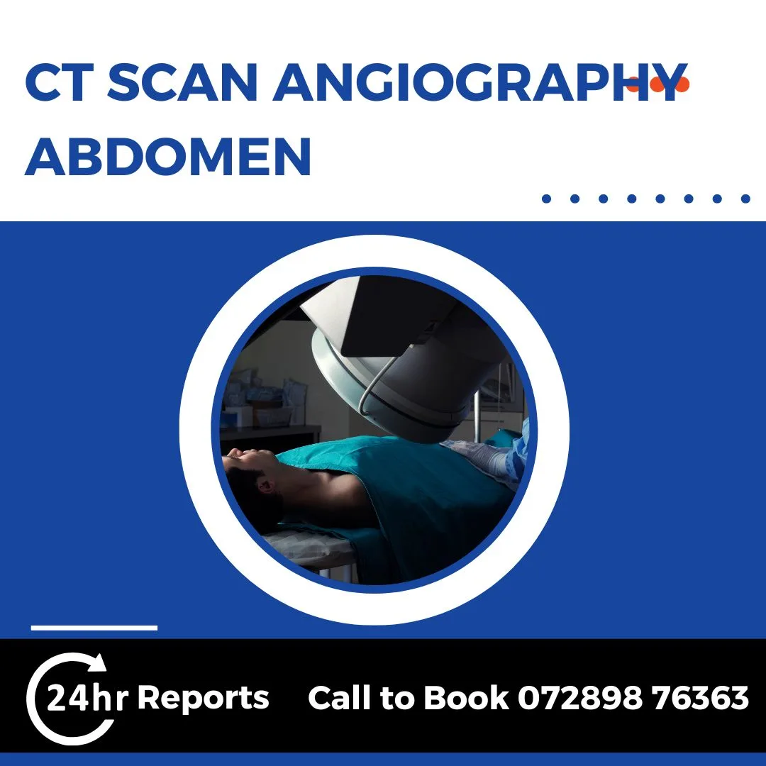 CT Scan Angiography Abdomen