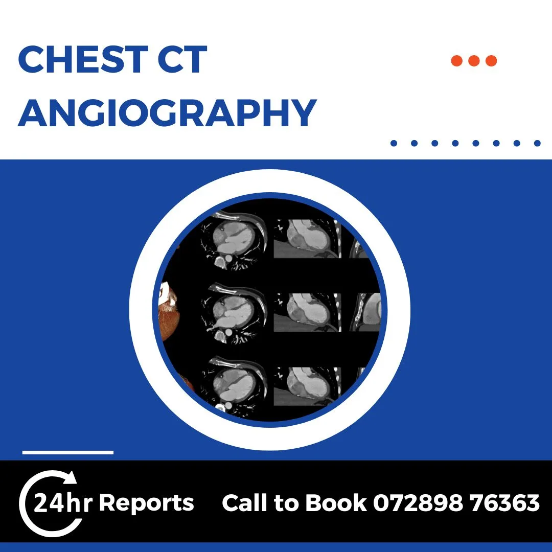 Chest CT Angiography