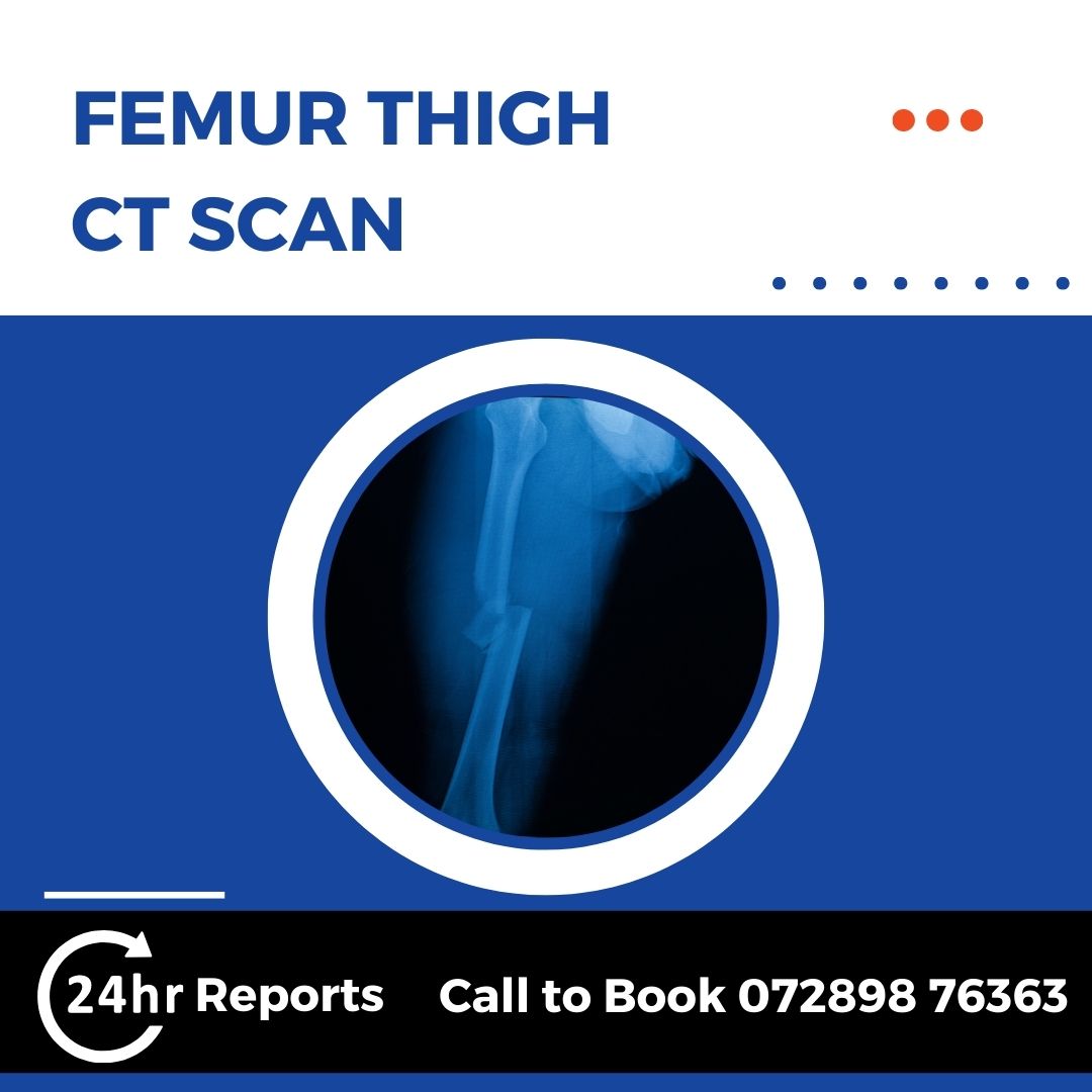 Femur Thigh CT Scan