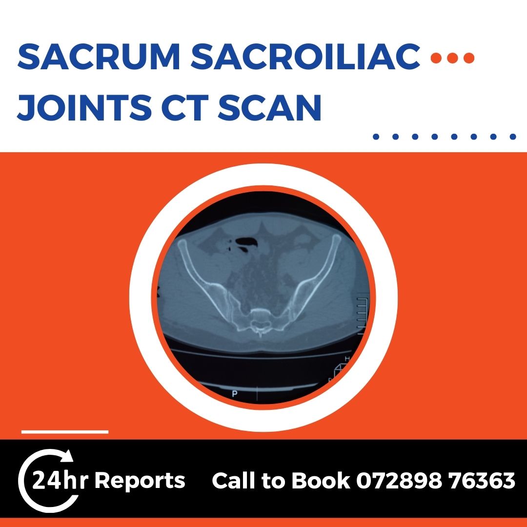 Sacrum Sacroiliac Joints CT Scan