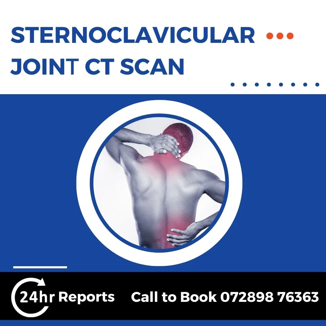 Sternoclavicular Joint CT Scan