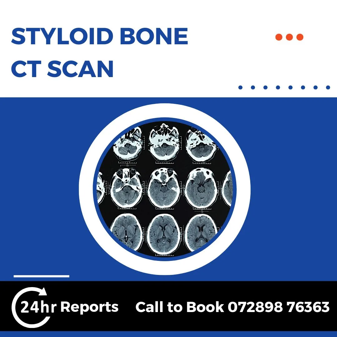 Styloid Bone CT Scan