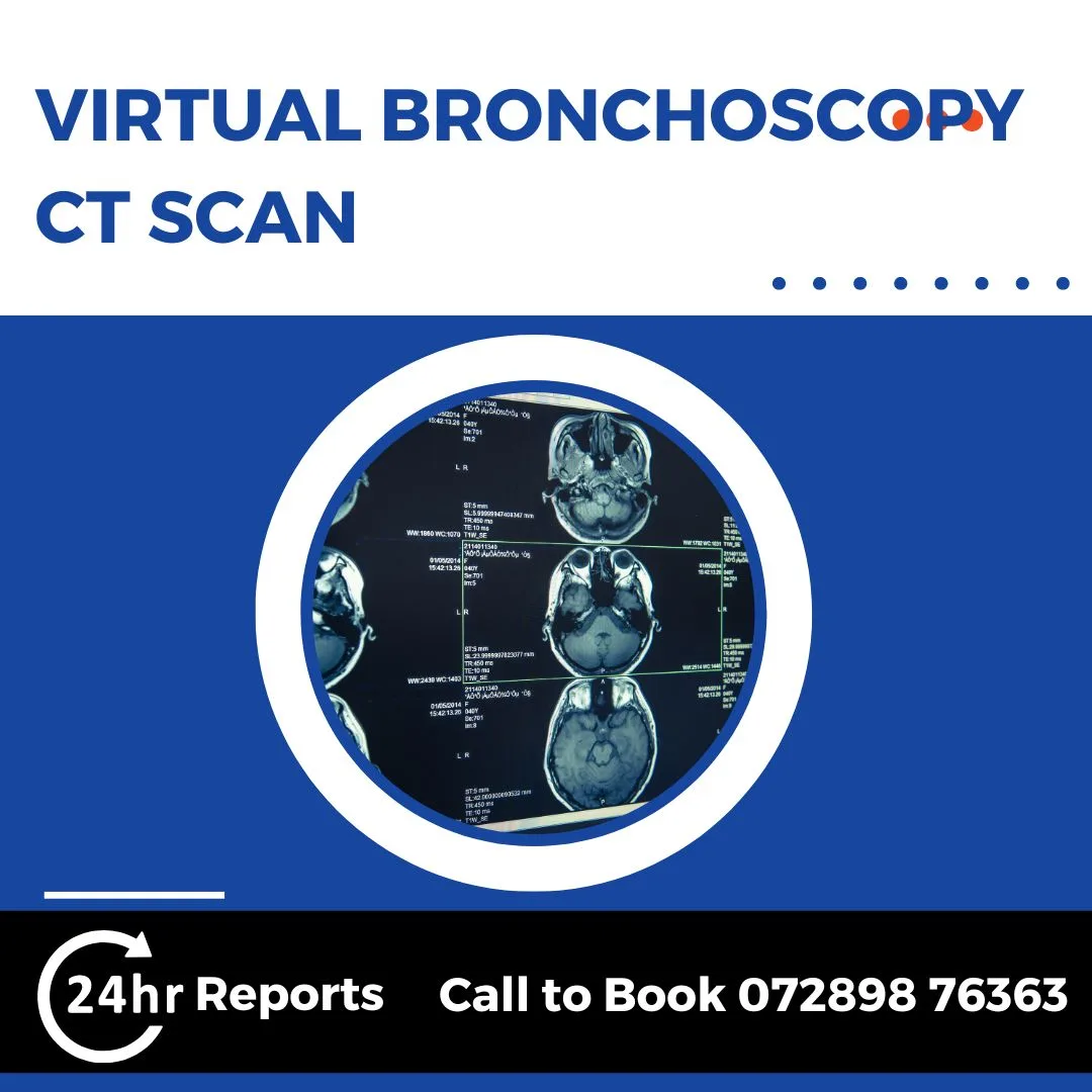 Virtual Bronchoscopy CT Scan